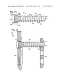 BONE FIXATION SYSTEM WITH OPPOSED MOUNTING PORTIONS diagram and image