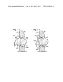 BONE FIXATION SYSTEM WITH OPPOSED MOUNTING PORTIONS diagram and image