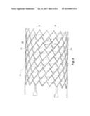 Highly Flexible Stent and Method of Manufacture diagram and image