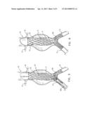 MULTI-COMPONENT BIFURCATED STENT-GRAFT SYSTEMS diagram and image