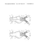 MULTI-COMPONENT BIFURCATED STENT-GRAFT SYSTEMS diagram and image