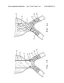 MULTI-COMPONENT BIFURCATED STENT-GRAFT SYSTEMS diagram and image