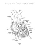 UNITARY QUICK-CONNECT PROSTHETIC HEART VALVE DEPLOYMENT METHODS diagram and image