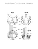 UNITARY QUICK-CONNECT PROSTHETIC HEART VALVE DEPLOYMENT METHODS diagram and image