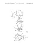 IMPLANTABLE WRIST JOINT ASSEMBLY WITH SPHERICAL INTER-SUPPORT diagram and image