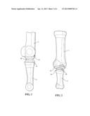 IMPLANTABLE HALLUX JOINT ASSEMBLY WITH SPHERICAL INTER-SUPPORT diagram and image