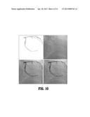 NON-RIGID 2D/3D REGISTRATION OF CORONARY ARTERY MODELS WITH LIVE     FLUOROSCOPY IMAGES diagram and image