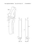 Percutaneous Fixator and Method of Insertion diagram and image