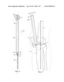 Percutaneous Fixator and Method of Insertion diagram and image