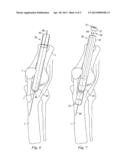 Percutaneous Fixator and Method of Insertion diagram and image