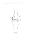 DYNAMIC KNEE BALANCER WITH FORCE OR PRESSURE SENSING diagram and image