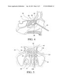 BALLOON CATHETERS AND METHODS FOR TREATING PARANASAL SINUSES diagram and image