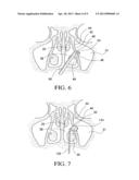 BALLOON CATHETERS AND METHODS FOR TREATING PARANASAL SINUSES diagram and image