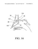 BALLOON CATHETERS AND METHODS FOR TREATING PARANASAL SINUSES diagram and image