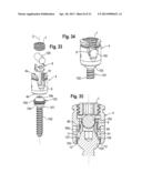 POLYAXIAL BONE ANCHORING SYSTEM diagram and image