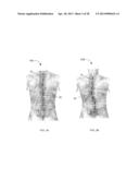 SYSTEM AND METHODS FOR CORRECTING SPINAL DEFORMITIES diagram and image