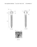 SYSTEM AND METHODS FOR CORRECTING SPINAL DEFORMITIES diagram and image