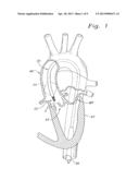 METHOD OF IMPLANTING A SELF-EXPANDABLE PROSTHETIC HEART VALVE diagram and image