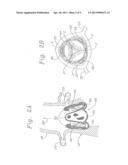 METHOD OF IMPLANTING A SELF-EXPANDABLE PROSTHETIC HEART VALVE diagram and image