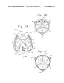 METHOD OF IMPLANTING A SELF-EXPANDABLE PROSTHETIC HEART VALVE diagram and image