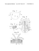 METHOD OF IMPLANTING A SELF-EXPANDABLE PROSTHETIC HEART VALVE diagram and image