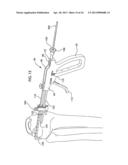 Instrumentation for repair of meniscus tissue diagram and image