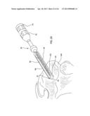 Instrumentation for repair of meniscus tissue diagram and image