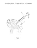 Instrumentation for repair of meniscus tissue diagram and image