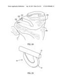 Instrumentation for repair of meniscus tissue diagram and image