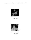 ANTI-ANGIOGENIC COMPOSITIONS AND METHODS OF USE diagram and image