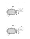 IONTOPHORETIC AND ELECTROOSMOTIC DISC TREATMENT diagram and image