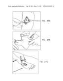 PROCEDURE FOR REPAIRING FOOT INJURY diagram and image