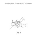 ULTRASONIC DEVICE FOR CUTTING AND COAGULATING diagram and image