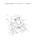 DISCECTOMY DEVICES AND RELATED METHODS diagram and image