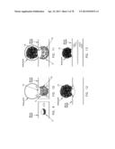 METHOD AND APPARATUS FOR RESTRICTING FLOW THROUGH AN OPENING IN THE SIDE     WALL OF A BODY LUMEN, AND/OR FOR REINFORCING A WEAKNESS IN THE SIDE WALL     OF A BODY LUMEN, WHILE STILL MAINTAINING SUBSTANTIALLY NORMAL FLOW     THROUGH THE BODY LUMEN diagram and image