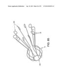 METHOD AND APPARATUS FOR RESTRICTING FLOW THROUGH AN OPENING IN THE SIDE     WALL OF A BODY LUMEN, AND/OR FOR REINFORCING A WEAKNESS IN THE SIDE WALL     OF A BODY LUMEN, WHILE STILL MAINTAINING SUBSTANTIALLY NORMAL FLOW     THROUGH THE BODY LUMEN diagram and image