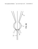 METHOD AND APPARATUS FOR RESTRICTING FLOW THROUGH AN OPENING IN THE SIDE     WALL OF A BODY LUMEN, AND/OR FOR REINFORCING A WEAKNESS IN THE SIDE WALL     OF A BODY LUMEN, WHILE STILL MAINTAINING SUBSTANTIALLY NORMAL FLOW     THROUGH THE BODY LUMEN diagram and image