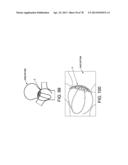 METHOD AND APPARATUS FOR RESTRICTING FLOW THROUGH AN OPENING IN THE SIDE     WALL OF A BODY LUMEN, AND/OR FOR REINFORCING A WEAKNESS IN THE SIDE WALL     OF A BODY LUMEN, WHILE STILL MAINTAINING SUBSTANTIALLY NORMAL FLOW     THROUGH THE BODY LUMEN diagram and image