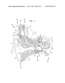 ELONGATE IMPLANTABLE CARRIER MEMBER HAVING AN EMBEDDED STIFFENER diagram and image