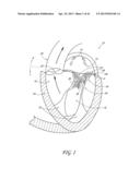 PERCUTANEOUS TRANSVALVULAR INTRAANNULAR BAND FOR MITRAL VALVE REPAIR diagram and image