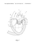 PERCUTANEOUS TRANSVALVULAR INTRAANNULAR BAND FOR MITRAL VALVE REPAIR diagram and image