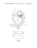 PERCUTANEOUS TRANSVALVULAR INTRAANNULAR BAND FOR MITRAL VALVE REPAIR diagram and image