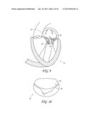 PERCUTANEOUS TRANSVALVULAR INTRAANNULAR BAND FOR MITRAL VALVE REPAIR diagram and image