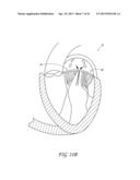 PERCUTANEOUS TRANSVALVULAR INTRAANNULAR BAND FOR MITRAL VALVE REPAIR diagram and image