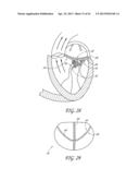 PERCUTANEOUS TRANSVALVULAR INTRAANNULAR BAND FOR MITRAL VALVE REPAIR diagram and image