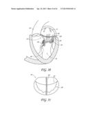 PERCUTANEOUS TRANSVALVULAR INTRAANNULAR BAND FOR MITRAL VALVE REPAIR diagram and image