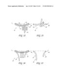 PERCUTANEOUS TRANSVALVULAR INTRAANNULAR BAND FOR MITRAL VALVE REPAIR diagram and image