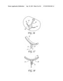 PERCUTANEOUS TRANSVALVULAR INTRAANNULAR BAND FOR MITRAL VALVE REPAIR diagram and image