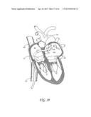 PERCUTANEOUS TRANSVALVULAR INTRAANNULAR BAND FOR MITRAL VALVE REPAIR diagram and image