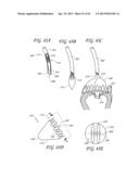 PERCUTANEOUS TRANSVALVULAR INTRAANNULAR BAND FOR MITRAL VALVE REPAIR diagram and image